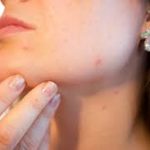 Acne & Pimples